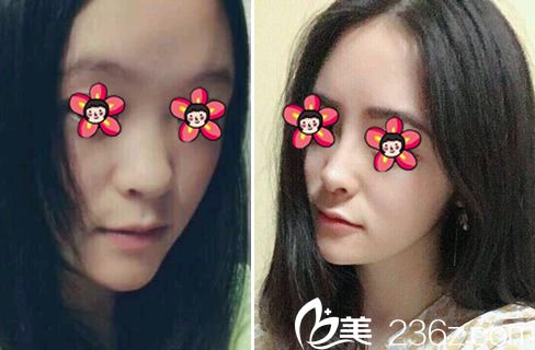 義烏張小紅鼻綜合隆鼻案例