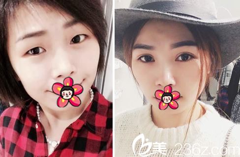 鄧亮醫(yī)生割雙眼皮開眼角案例