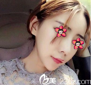 在義烏張小紅整形做隆鼻2月后 在義烏張小紅整形做隆鼻2月后