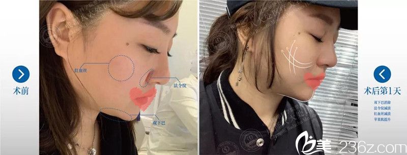 成都<!--<i data=20240709-sp></i>-->整形王萍線雕案例