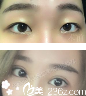 成都<!--<i data=20240709-sp></i>-->于曉波雙眼皮術(shù)后照片 成都<!--<i data=20240709-sp></i>-->于曉波雙眼皮術(shù)后照片