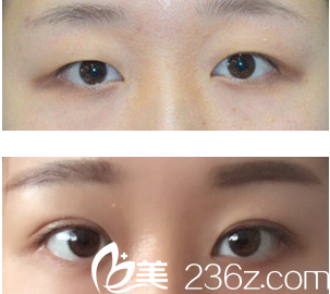 于曉波微創(chuàng)三點(diǎn)雙眼+開眼角 于曉波微創(chuàng)三點(diǎn)雙眼+開眼角