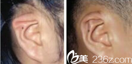 <!--<i data=20240709-sp></i>-->于曉波耳畸形修復(fù)術(shù)后效果 <!--<i data=20240709-sp></i>-->于曉波耳畸形修復(fù)術(shù)后效果