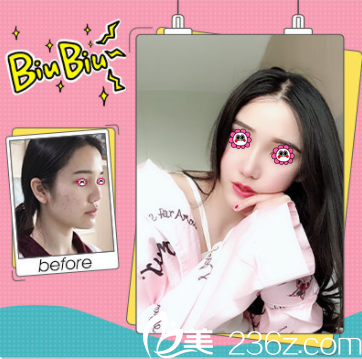 北京壹加壹蒙特鼻多少錢？隆鼻價格表和案例搶先看