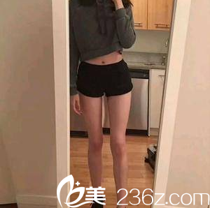 在北京畫美醫(yī)院做腿部吸脂第31天<span style=