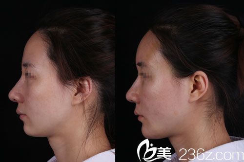 <!--<i data=20240709-sp></i>-->李發(fā)成自體脂肪面部填充對比 <!--<i data=20240709-sp></i>-->李發(fā)成自體脂肪面部填充對比