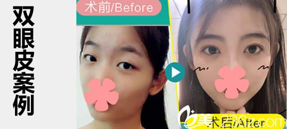 福州臺(tái)江徐婷婷雙眼皮案例 福州臺(tái)江徐婷婷雙眼皮案例