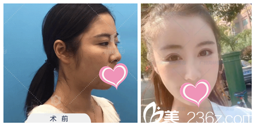 李希軍隆鼻案例效果對(duì)比圖