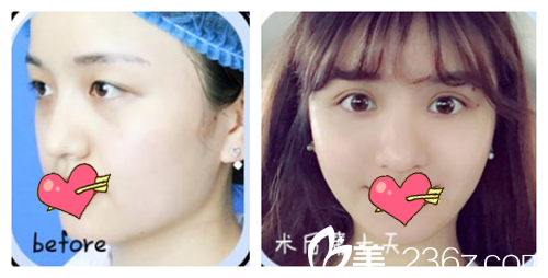 廣州海峽郭棟雙眼皮案例術(shù)前術(shù)后十天效果