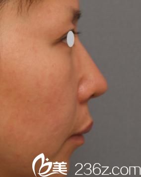 高須克彌醫(yī)生到底怎么樣?看日本高須美容整形的高須克彌醫(yī)生為我做的鼻尖軟骨移植