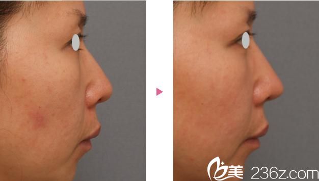 鼻尖軟骨移植前后對比 鼻尖軟骨移植前后對比