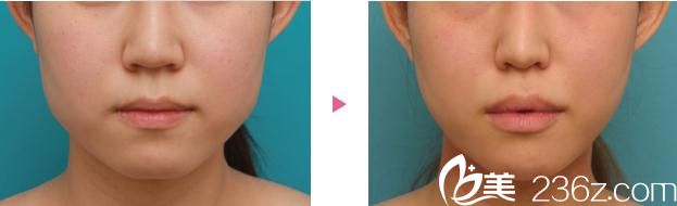 臉型整形前后對(duì)比 臉型整形前后對(duì)比