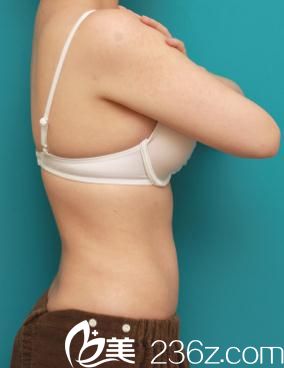 高須克彌醫(yī)生在日本高須美容整形醫(yī)院做的吸脂手術(shù)前后對比，從此楊柳細(xì)腰、窈窕動人!