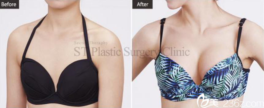 韓國(guó)ST整形外科案例