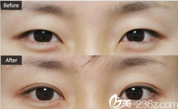 韓國(guó)ST整形外科醫(yī)院案例