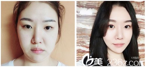 韓國dreamline吸脂塑形醫(yī)院面部吸脂<span style= 韓國dreamline吸脂塑形醫(yī)院面部吸脂<span style=