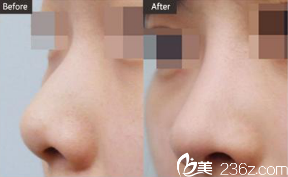 韓國(guó)ST整形醫(yī)院短鼻/鷹鉤鼻對(duì)比圖