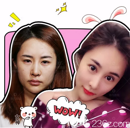 深圳非凡易培金雙眼皮案例對比圖片