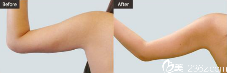 韓國(guó)ST整形醫(yī)院吸脂術(shù)對(duì)比圖