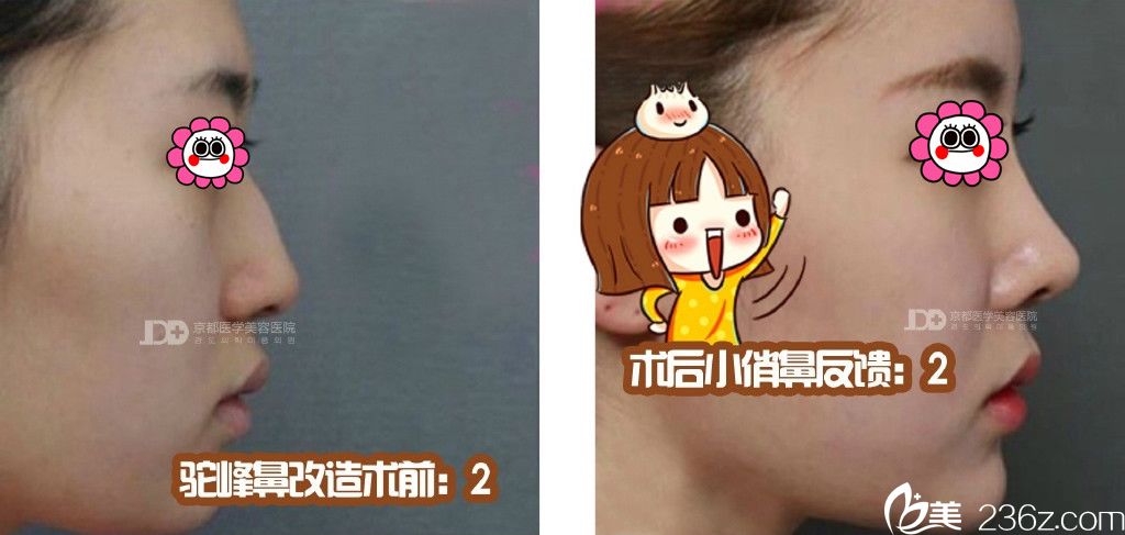 保定京都整形隆鼻前后對比照
