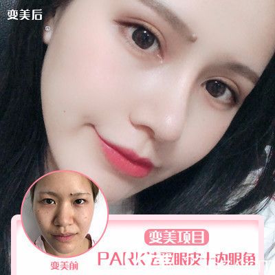 深圳非凡黃純做的雙眼皮開眼角案例