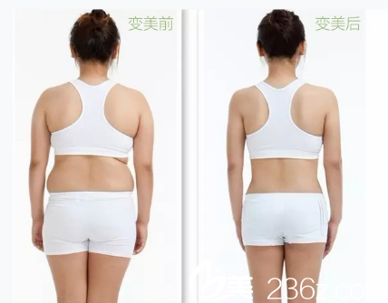 深圳非凡黃純做的腰腹部吸脂案例