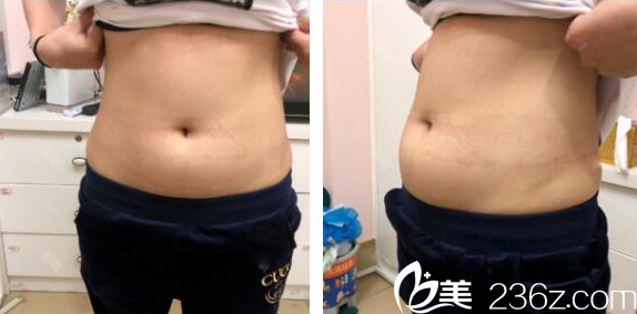 腰腹部吸脂術(shù)前照片 腰腹部吸脂術(shù)前照片