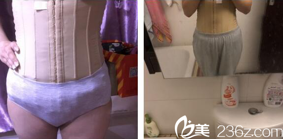 在深圳非凡醫(yī)院做完吸脂兩天了 在深圳非凡醫(yī)院做完吸脂兩天了