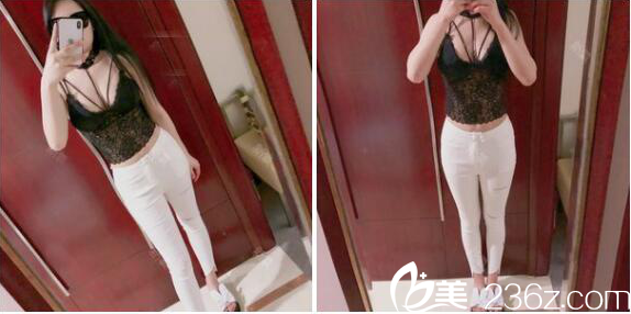 深圳非凡醫(yī)院腰腹部吸脂一個月效果展示 深圳非凡醫(yī)院腰腹部吸脂一個月效果展示