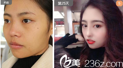 整形文科雙眼皮隆鼻術(shù)后效果 整形文科雙眼皮隆鼻術(shù)后效果