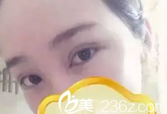 做完雙眼皮和開眼角3天恢復(fù)照