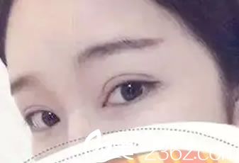 做完雙眼皮12天恢復(fù)<span style=