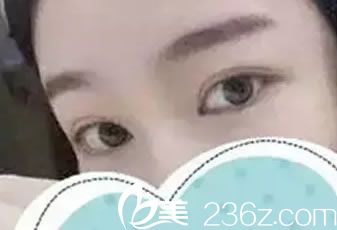 看到衢州桂美人袁細(xì)牙有多年眼鼻手術(shù)經(jīng)驗(yàn),就放心地找他做了雙眼皮和開(kāi)眼角