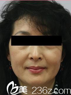 奇跡線雕面部提升術(shù)前 奇跡線雕面部提升術(shù)前