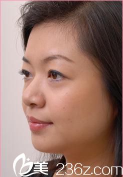 日本哪個(gè)醫(yī)生微整注射技術(shù)好?找自由之丘的玻尿酸注射醫(yī)生古山登隆為我注射玻尿酸的經(jīng)歷