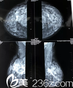 拍片之后的樣子 拍片之后的樣子