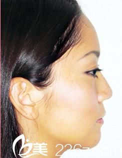 我的日本混血整形體驗(yàn)---自由之丘佐藤英明醫(yī)生做的隆鼻術(shù)前后效果對(duì)比