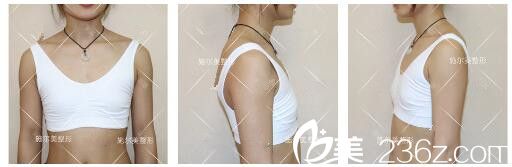 面診呂韓偉醫(yī)生術(shù)前干癟的胸部 面診呂韓偉醫(yī)生術(shù)前干癟的胸部