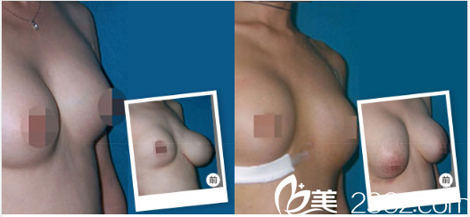 廣州海峽醫(yī)療整形美容醫(yī)院譚新東術(shù)前照片1