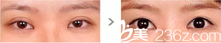 沈割雙眼皮怎么樣？眼部修復(fù)案例
