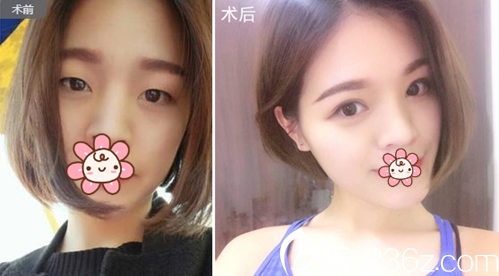 雙眼皮開眼角術(shù)后效果