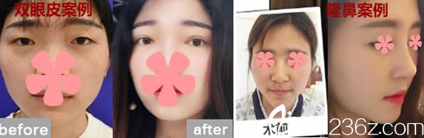 福州瑪恩徐杰醫(yī)生雙眼皮及鼻綜合隆鼻案例