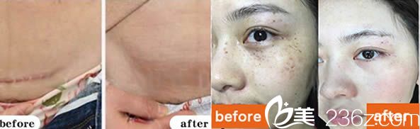 福州瑪恩劉劍剖腹產(chǎn)祛疤痕案例及激光祛斑前后對比效果