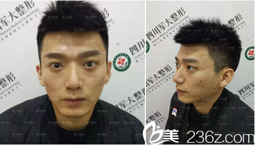 面部脂肪填充術(shù)前照片 面部脂肪填充術(shù)前照片