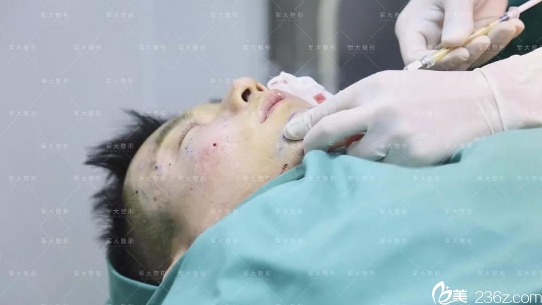 自體脂肪填充面部手術(shù)中 自體脂肪填充面部手術(shù)中