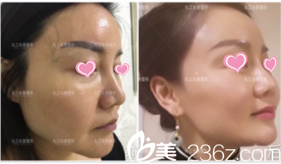 九江臺美治療真人案例全程展示：擺脫法令紋、蘋果肌下垂、無懼年齡變更美