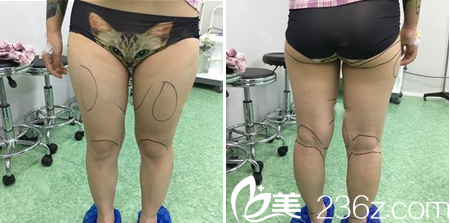 大小腿吸脂術(shù)前設(shè)計 大小腿吸脂術(shù)前設(shè)計
