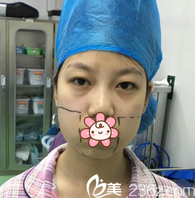 <i data-id='82eb1d34-6b77-4d6f-a381-8bd7586dfd21' style='display:none;'></i>蒲小兵臉部吸脂術(shù)前設(shè)計 <i data-id='82eb1d34-6b77-4d6f-a381-8bd7586dfd21' style='display:none;'></i>蒲小兵臉部吸脂術(shù)前設(shè)計