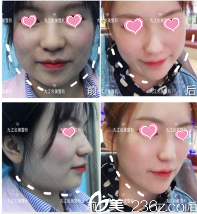 分享下我在九江臺美注射瘦臉后輕松擁有小V臉的蛻變經(jīng)歷吧