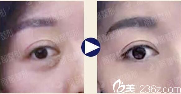 在無錫麗都做微創(chuàng)去眼袋術(shù)前術(shù)后對比案例 在無錫麗都做微創(chuàng)去眼袋術(shù)前術(shù)后對比案例